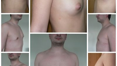 Гинекомастията (увеличение на млечната жлеза)