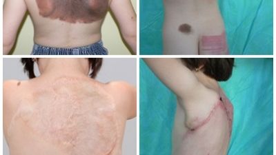 Последствия от изгаряне, реконструктивна хирургия